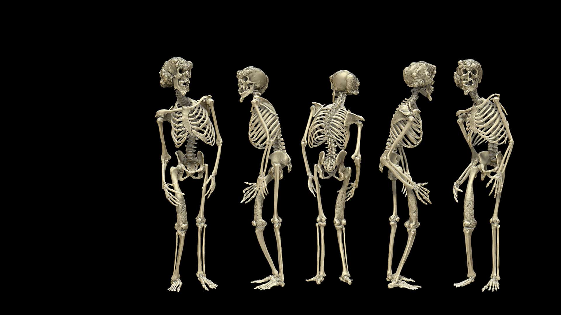 Три типа скелета. Скелет Джозефа Меррика.